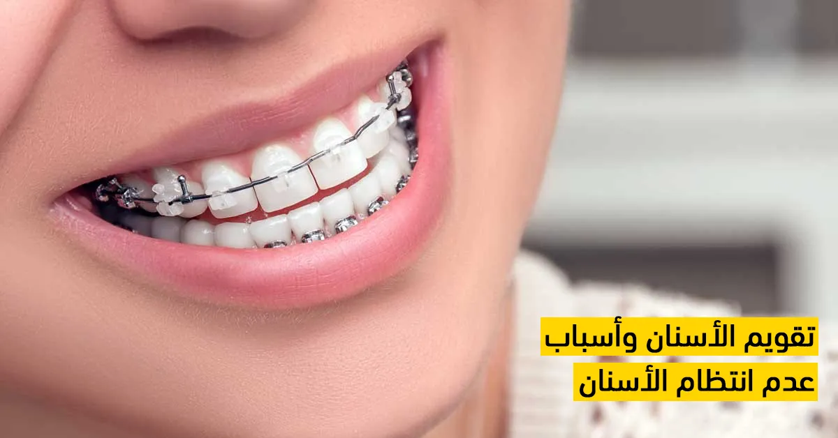 تقويم الأسنان وأسباب عدم انتظام الأسنان